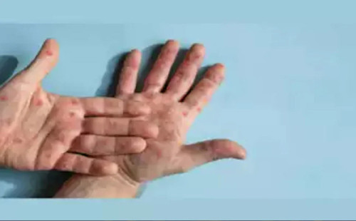 পাকিস্তানে প্রথম মাঙ্কিপক্স রোগী শনাক্ত